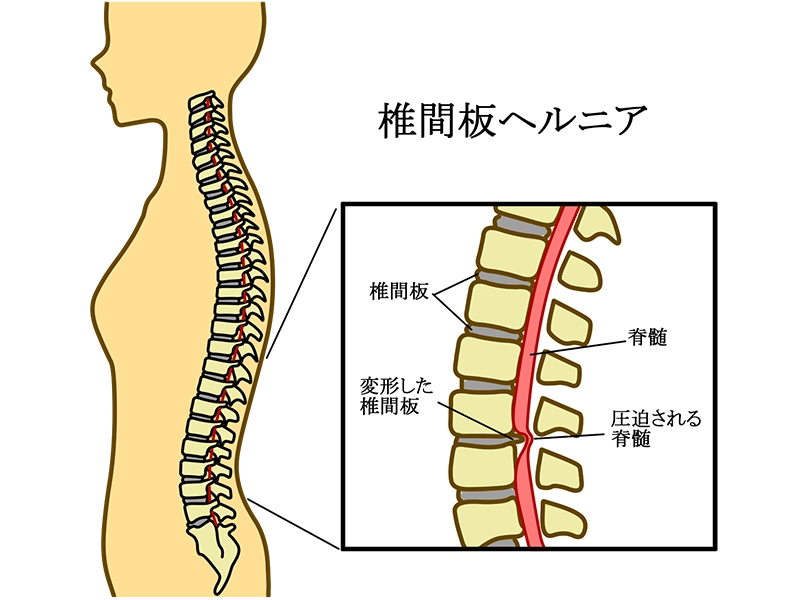 椎間板ヘルニアの症状の説明