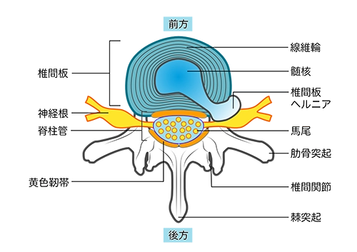 椎間板ヘルニアの原因と椎間板