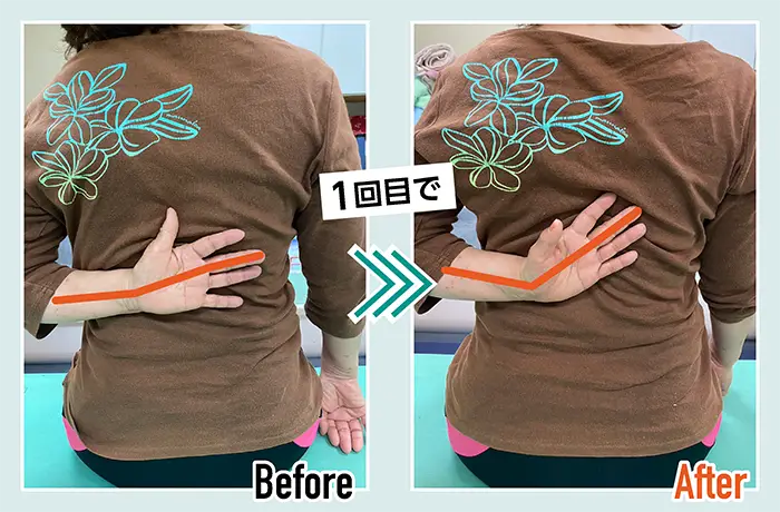 肩痛の患者ビフォーアフター