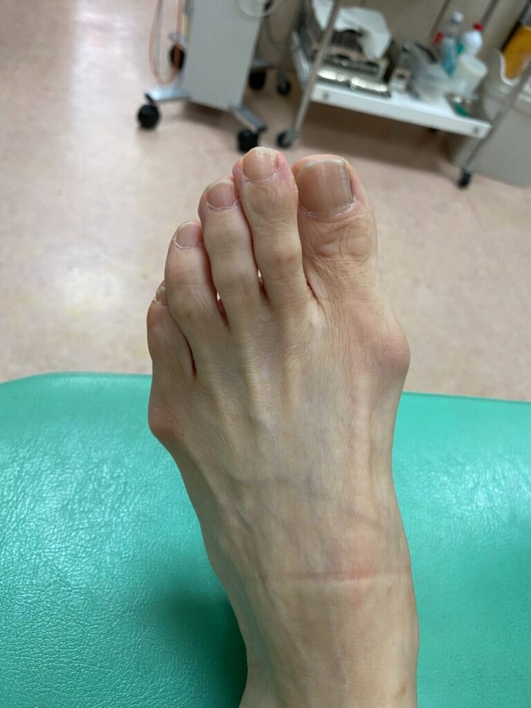 治療前の外反母趾と内反小趾