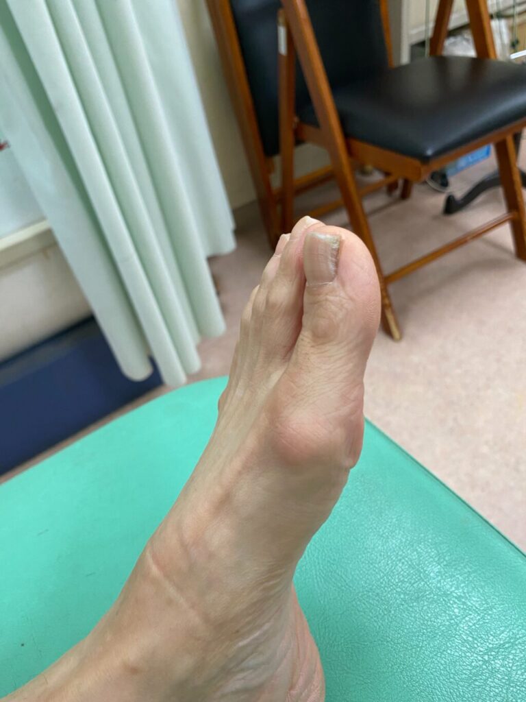 施術後の拇指