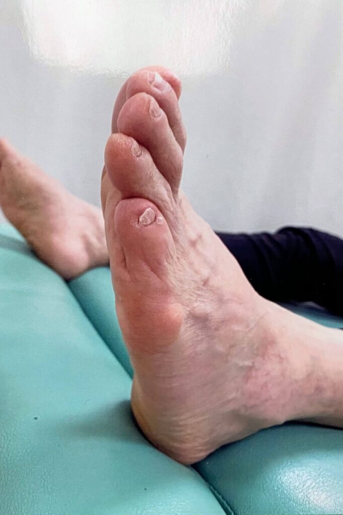 施術後、足指の変形が大幅に緩和