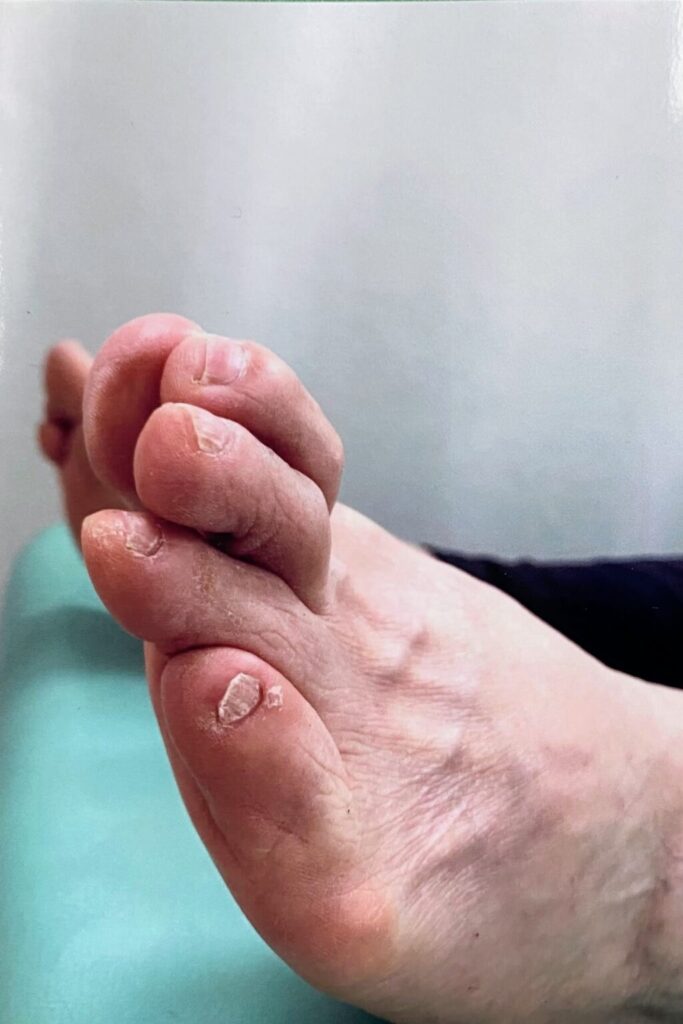 施術前の変形した足指