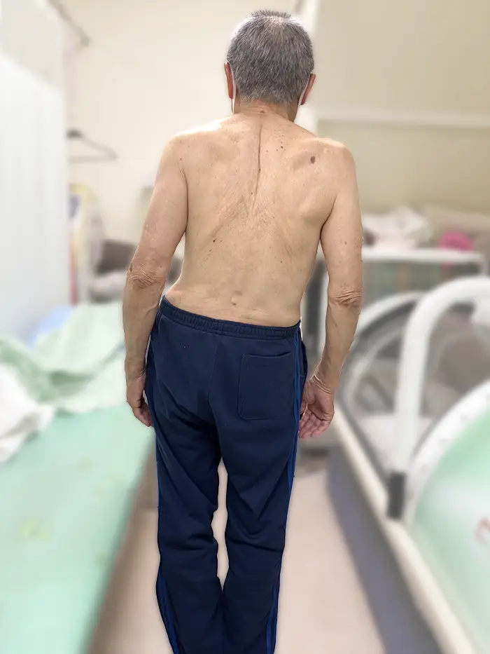 根本整体施術後の81歳男性26年7月　重心バランスが改善してきた
