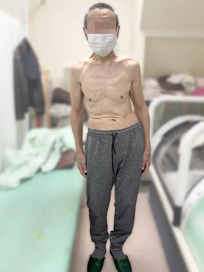 根本整体施術後の81歳男性26年7月　重心バランスが改善してきた