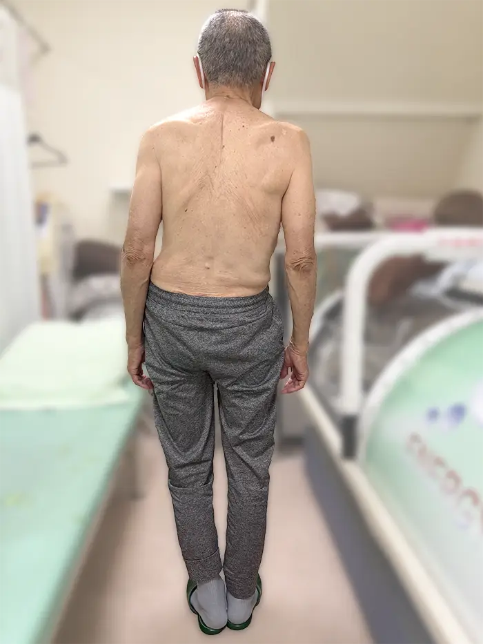 根本整体施術後の81歳男性26年8月　重心バランスが整ってきた
