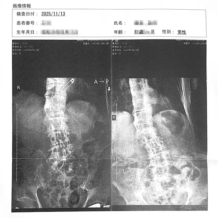 レントゲン写真-81歳男性-側弯症