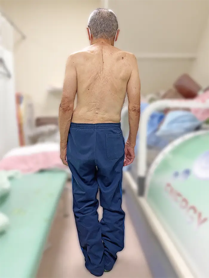 施術前の81歳男性26年9月 まっすぐ立てるようにだいぶ改善