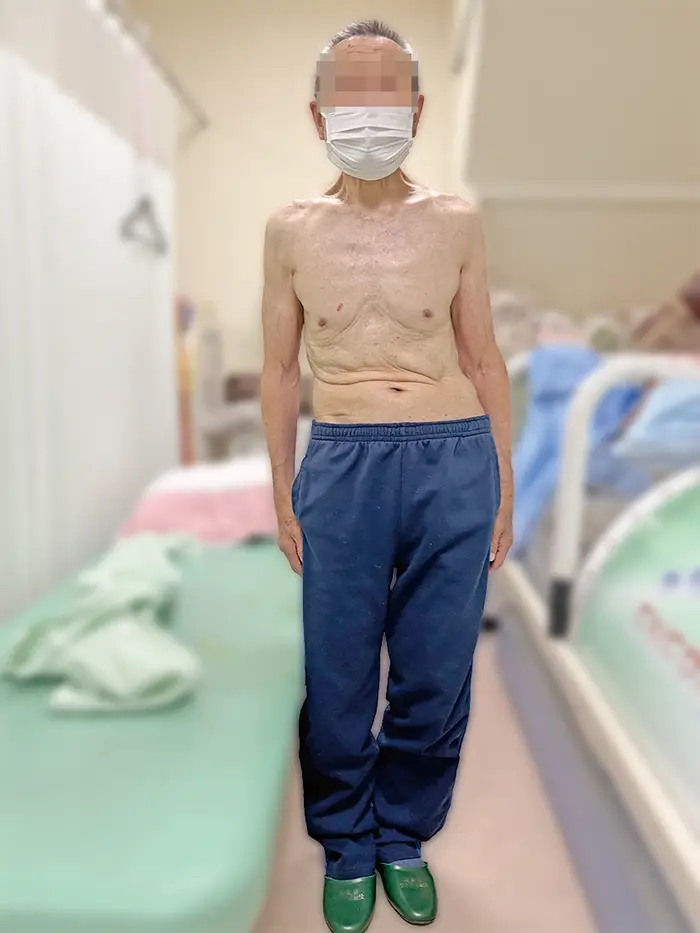 施術前の81歳男性26年9月 まっすぐ立てるようにだいぶ改善